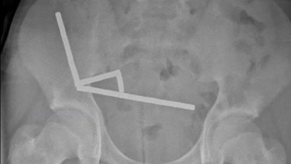 100 tane mıknatıs yuttu!