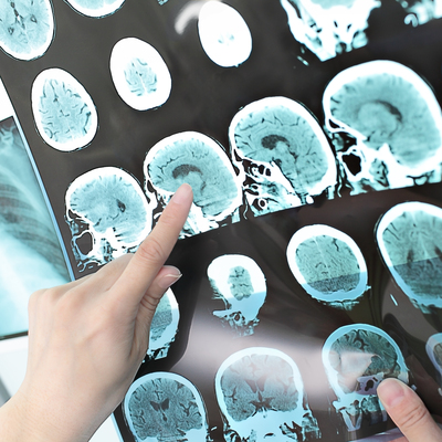 Nörolojik hastalıklarda kök hücre tedavisi deneysel aşamada