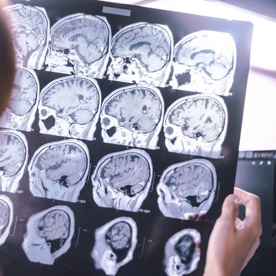 Birleşik Krallık'ta Parkinson teşhisi krizi