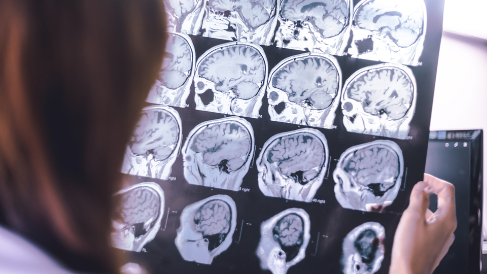 Birleşik Krallık'ta Parkinson teşhisi krizi