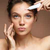 Akneyi daha kötü yapan 10 alışkanlık