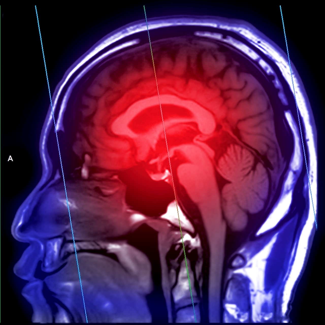 İnme riski gençlerde de artıyor