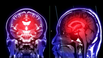 İnme riski gençlerde de artıyor