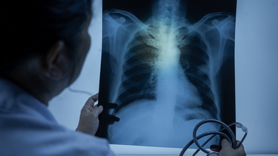 50 yaş üstü sigara içicilerine 'tomografi' uyarısı!