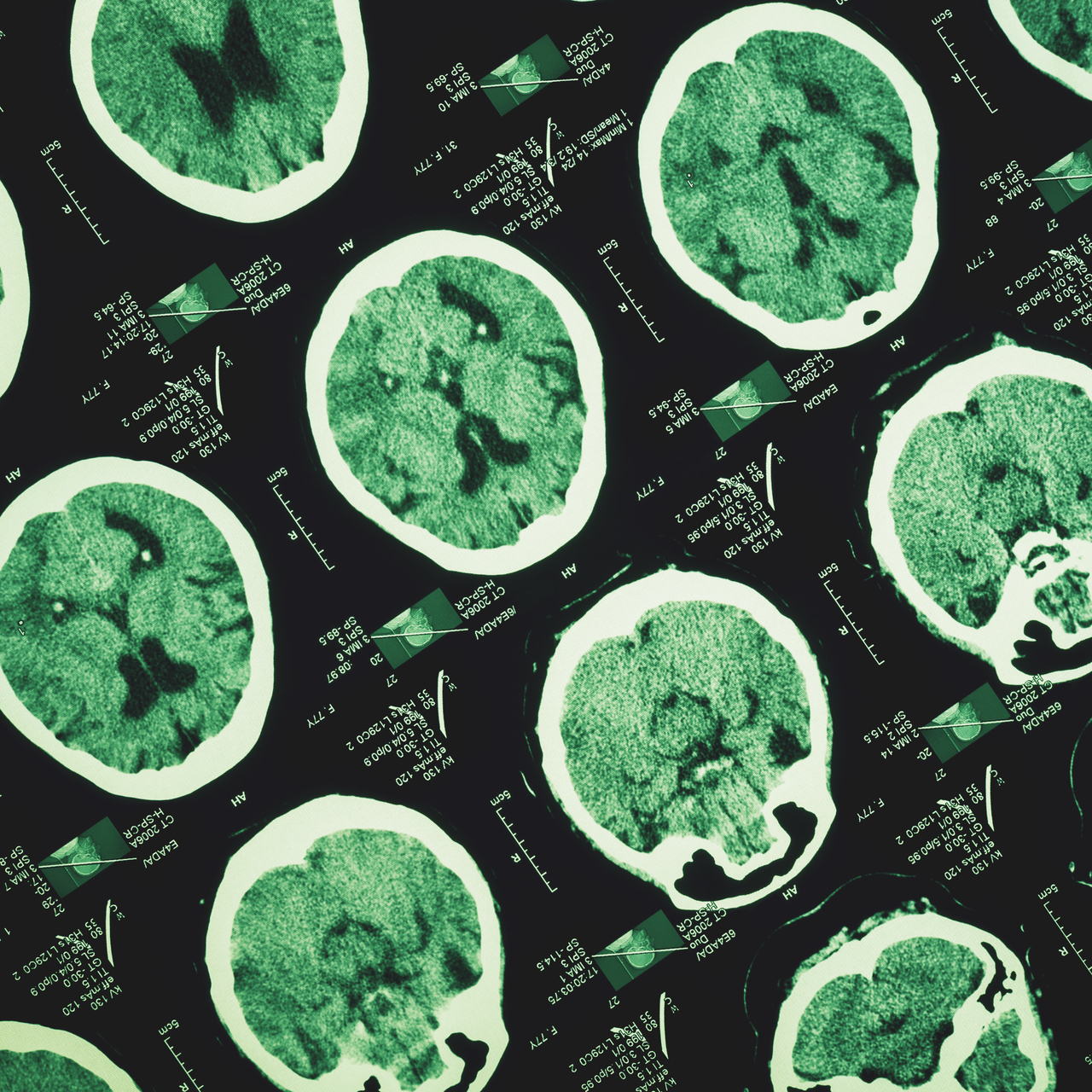 Günde en az 3 bin adım atmak Alzheimer'ın ilerlemesini yavaşlatabilir