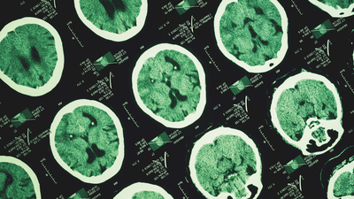 Günde en az 3 bin adım atmak Alzheimer'ın ilerlemesini yavaşlatabilir