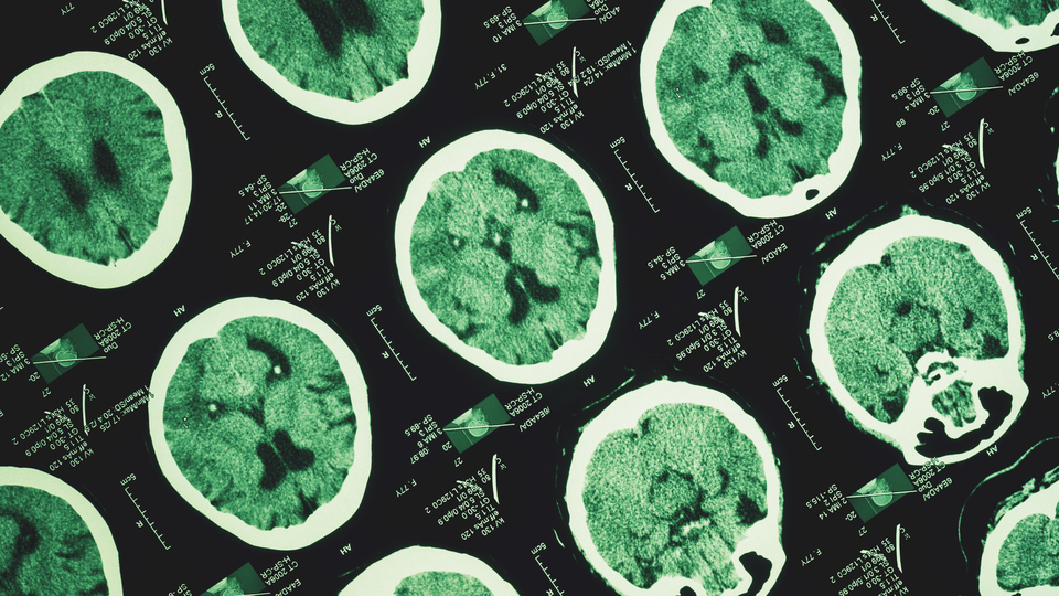 Günde en az 3 bin adım atmak Alzheimer'ın ilerlemesini yavaşlatabilir