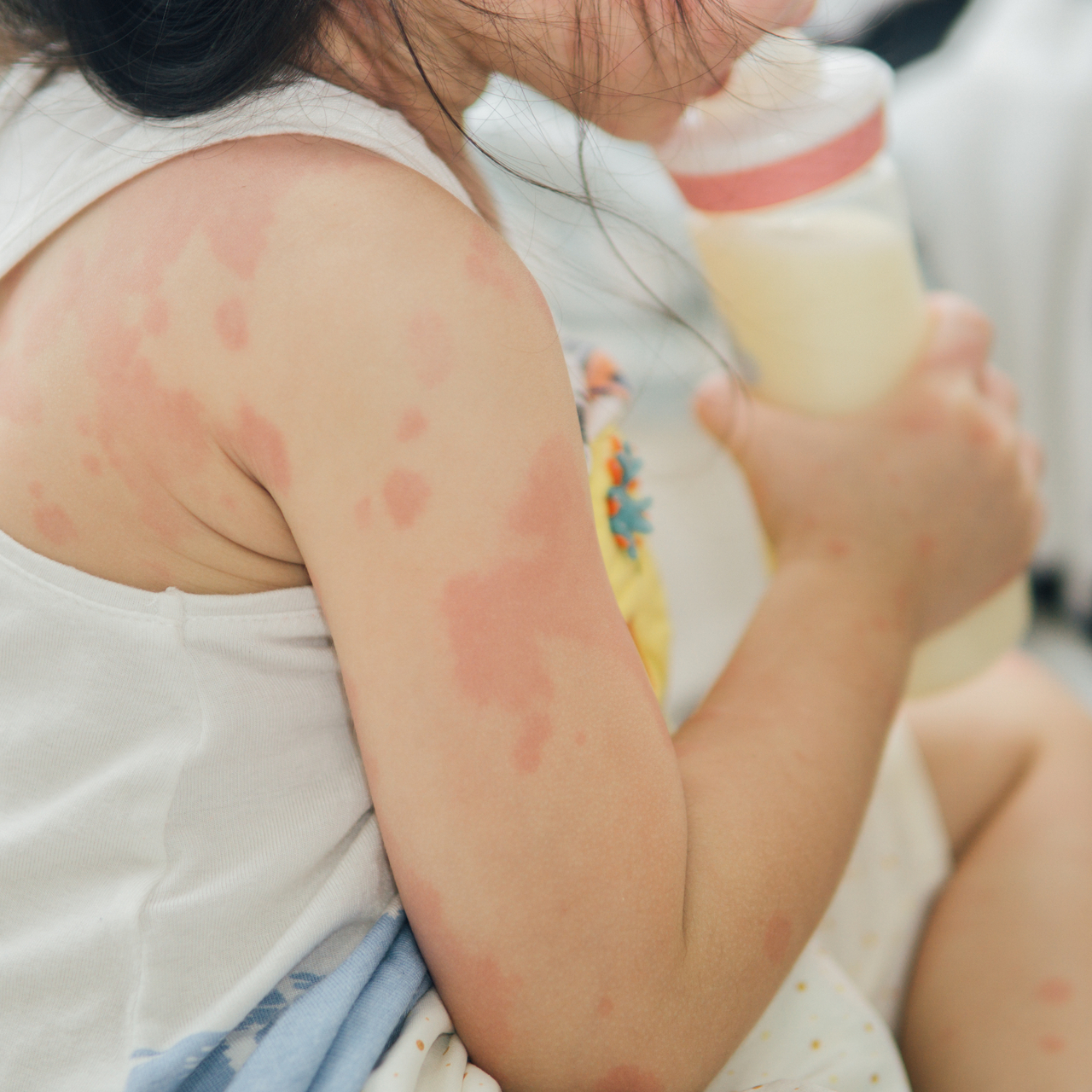 Bebeklerde ve çocuklarda alerji! Neleri yanlış biliyoruz?