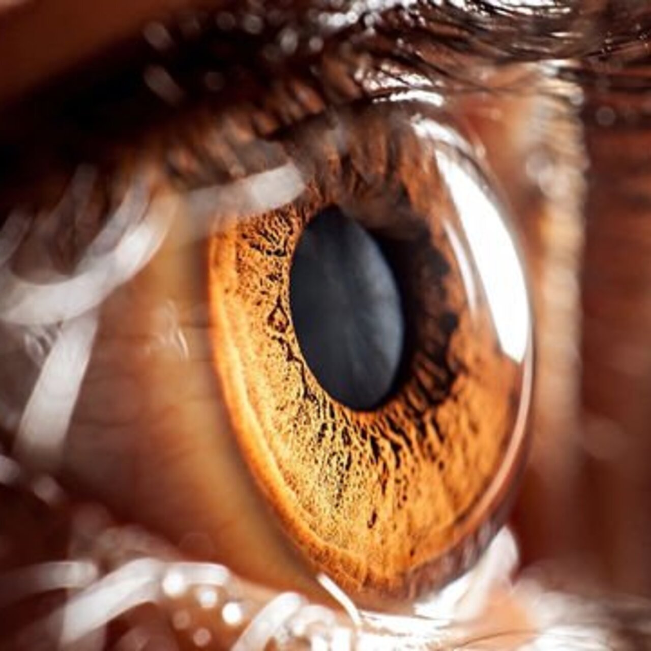 Göz tansiyonu ve katarakt, en çok diyabetlilerde görülüyor