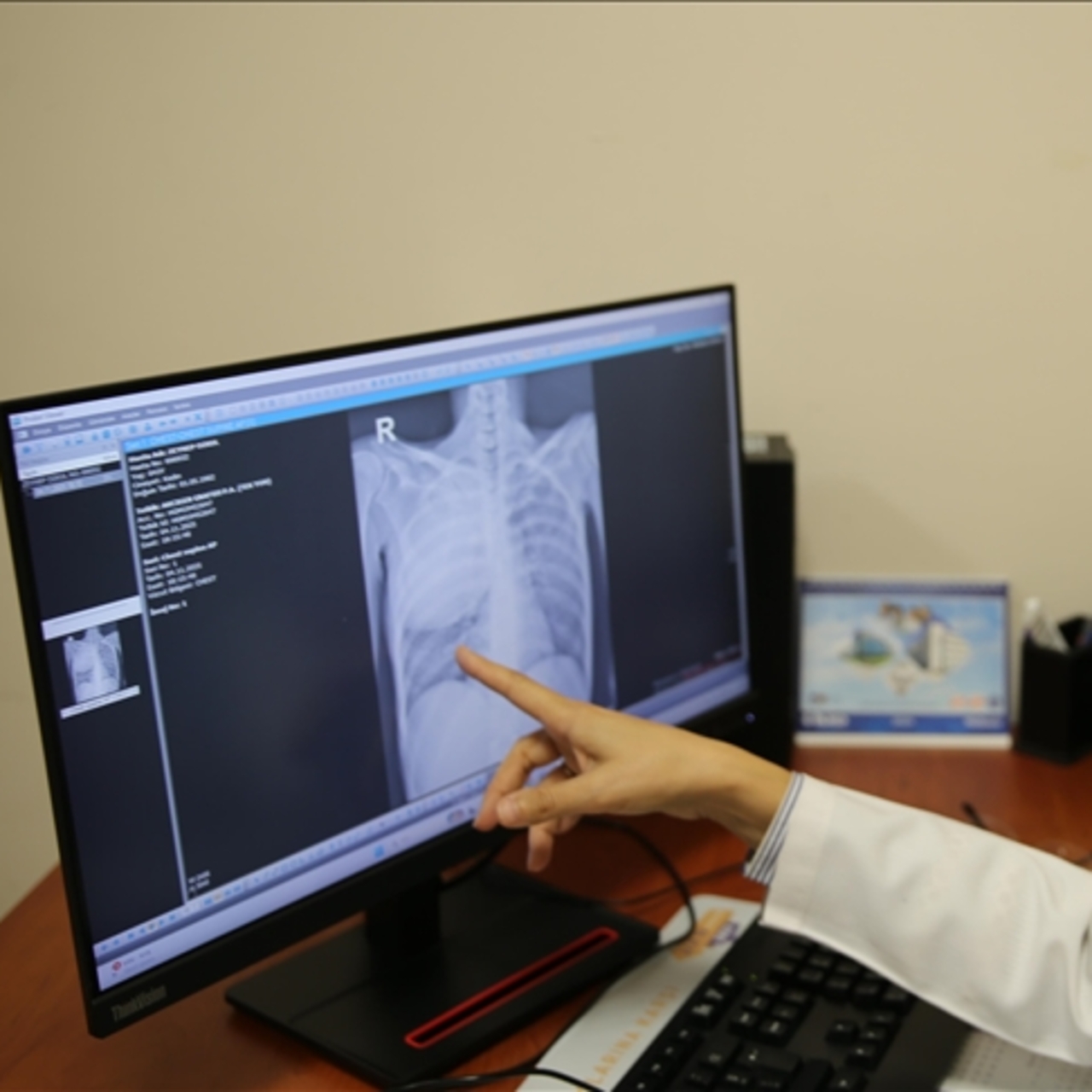 Akciğer kanserinde erken teşhis uyarısı!