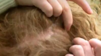 Kafasında iğne unutuldu!