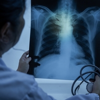 Akciğer kanserinde çevresel faktörlerin etkisi artıyor