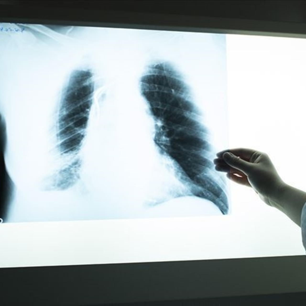 Sigara kullanan 45 yaş üzeri 4 kişiden birinde KOAH görülüyor