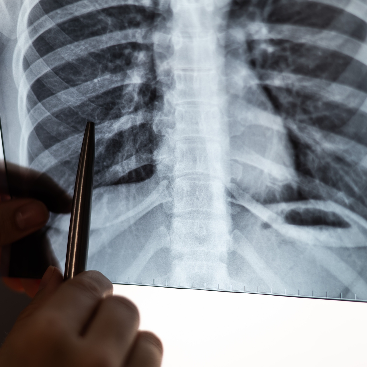 KOAH hastalarının çoğu KOAH olduğunu bilmiyor