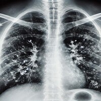 Prof. Dr. Şener'den 'süperenfeksiyon' uyarısı!