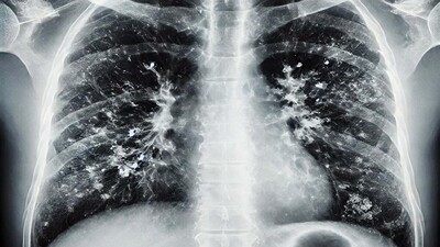 Prof. Dr. Şener'den 'süperenfeksiyon' uyarısı!