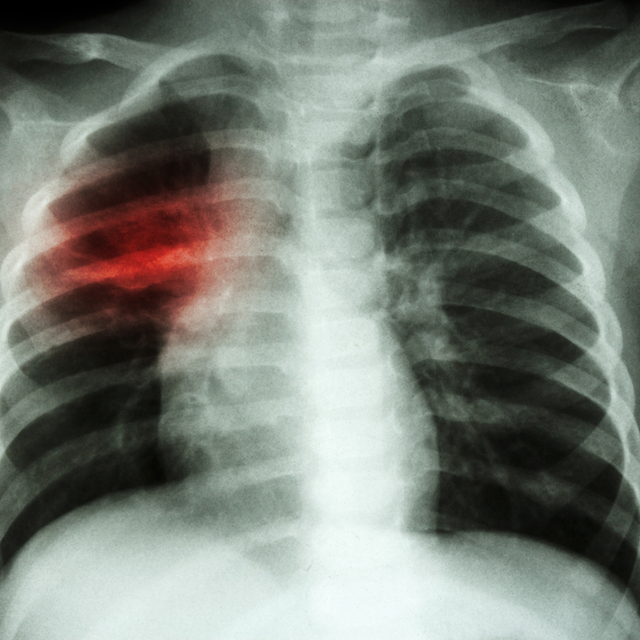 Günde 150 kişi akciğer kanseri teşhisi alıyor