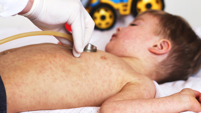 Çocuklarda kronik ürtiker uyku ve yaşam kalitesini düşürüyor