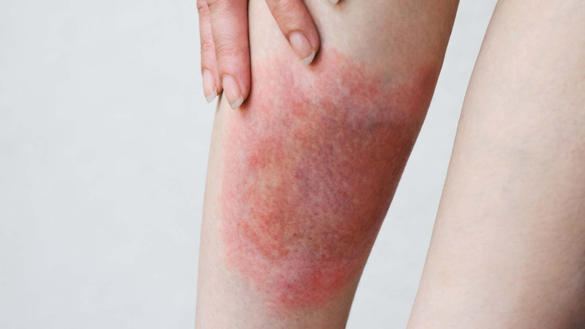 Hollywood ünlüleri peş peşe bu hastalığa yakalandığını açıklıyor: Peki nedir bu "lyme" hastalığı?