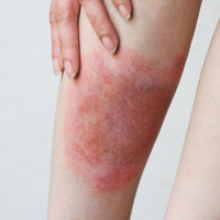 Hollywood ünlülerinden peş peşe açıklama: Lyme hastalığı