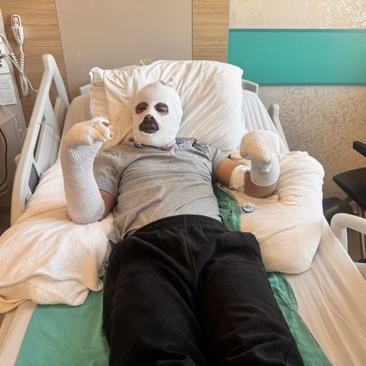 Gaz kaçağını farketmedi vücudu yandı