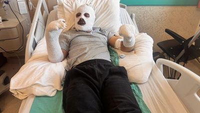 Gaz kaçağını farketmedi vücudu yandı