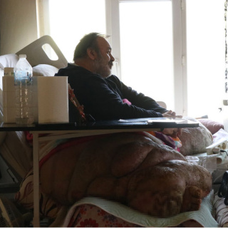 5 yıldır evden çıkmıyor! Fil hastasının hayali eşiyle kol kola caddede gezmek