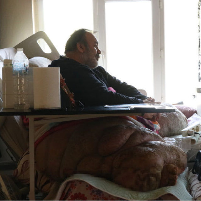 5 yıldır evden çıkmıyor! Fil hastasının hayali eşiyle kol kola caddede gezmek