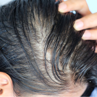 Yağlı saç sorununa doğal ve etkili çözümler