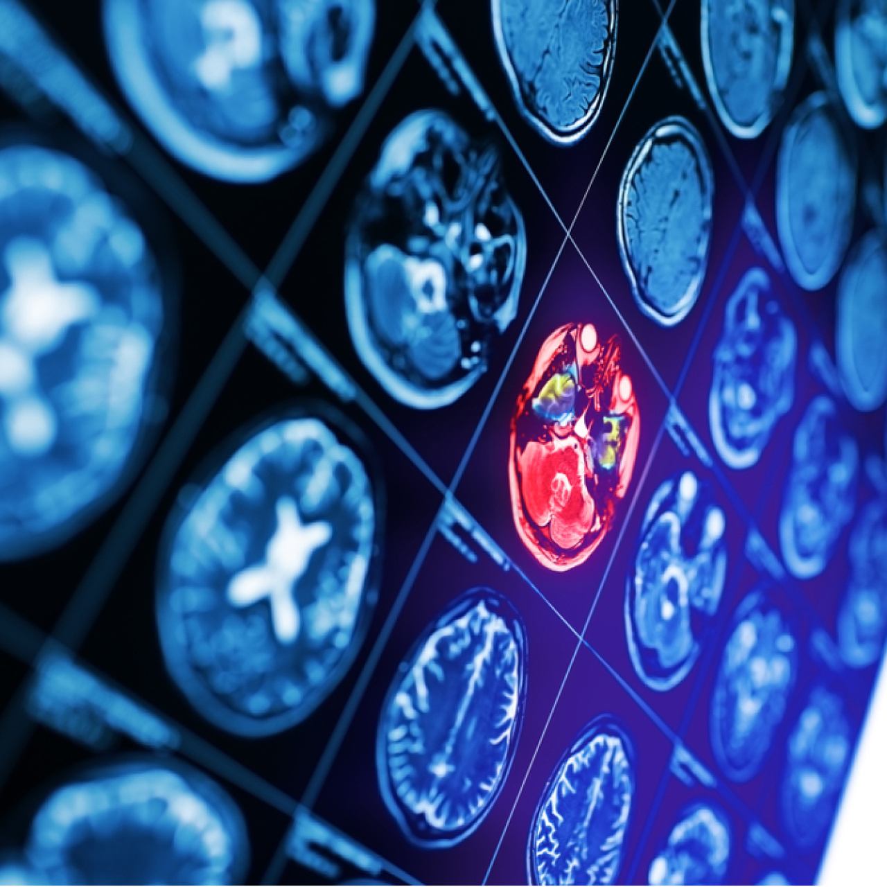 İnmede yanlış müdahalelere dikkat! Hayati riski artırıyor