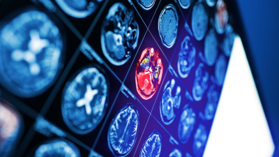 İnme sırasında yapılan yanlış müdahaleler hayati riski artırıyor