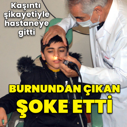 Kaşıntı şikayetiyle hastaneye giden Emirhan'ın burnundan çekirdek ve pipet parçası çıktı