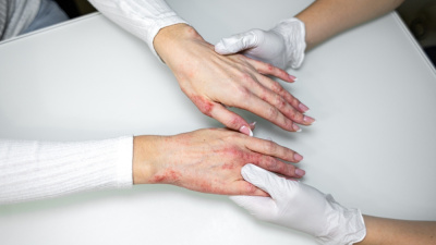 Kışın bu hatalar egzama şikayetlerini artırıyor