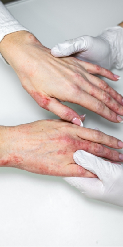 Kışın bu hatalar egzama şikayetlerini artırıyor