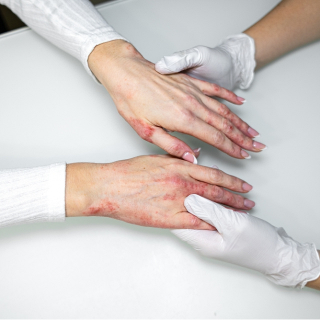 Kışın bu hatalar egzama şikayetlerini artırıyor