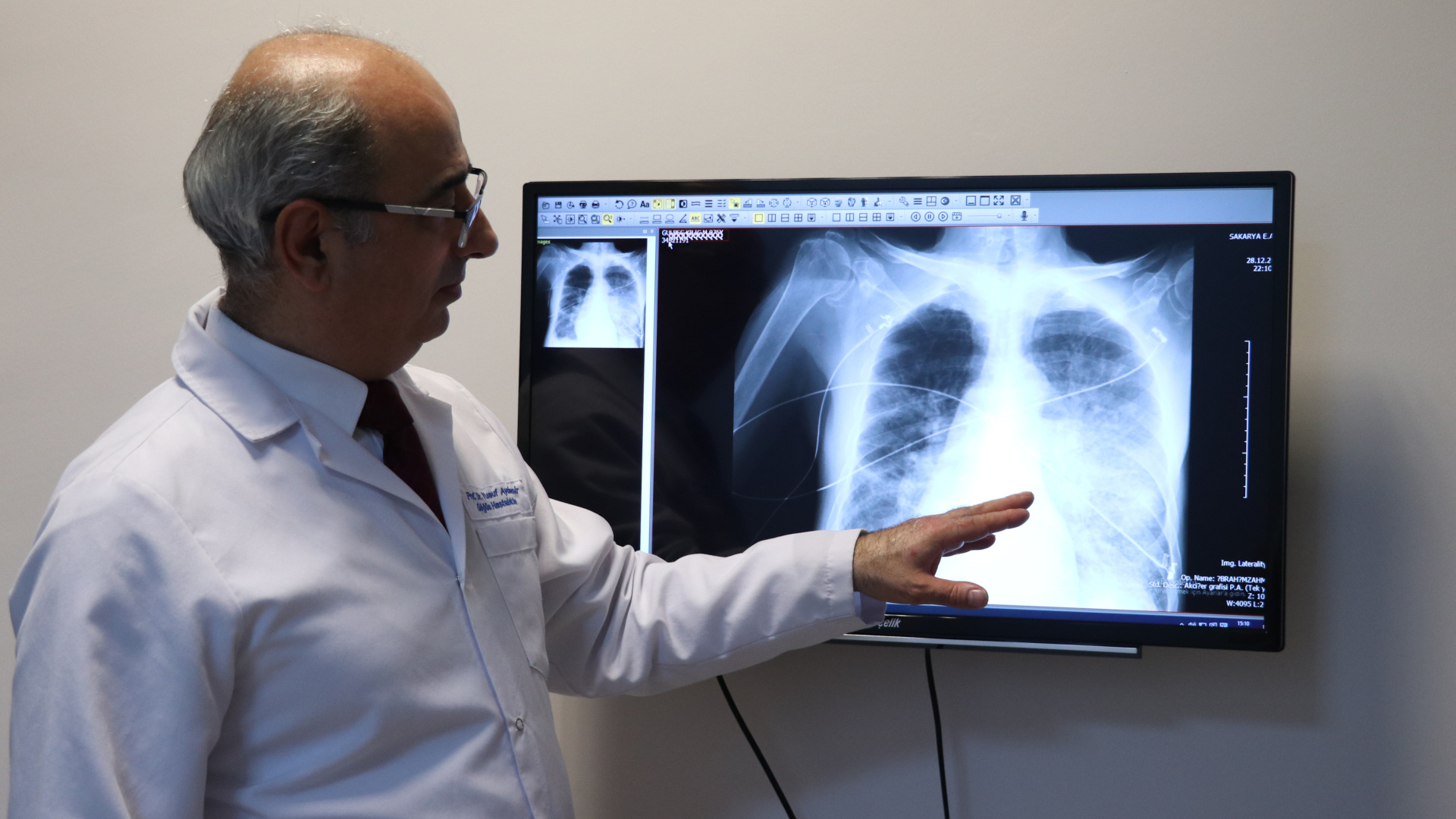 Elektronik sigaranın akciğerde yol açtığı hasar yoğun bakımla sonuçlanıyor | Sağlık Haberleri