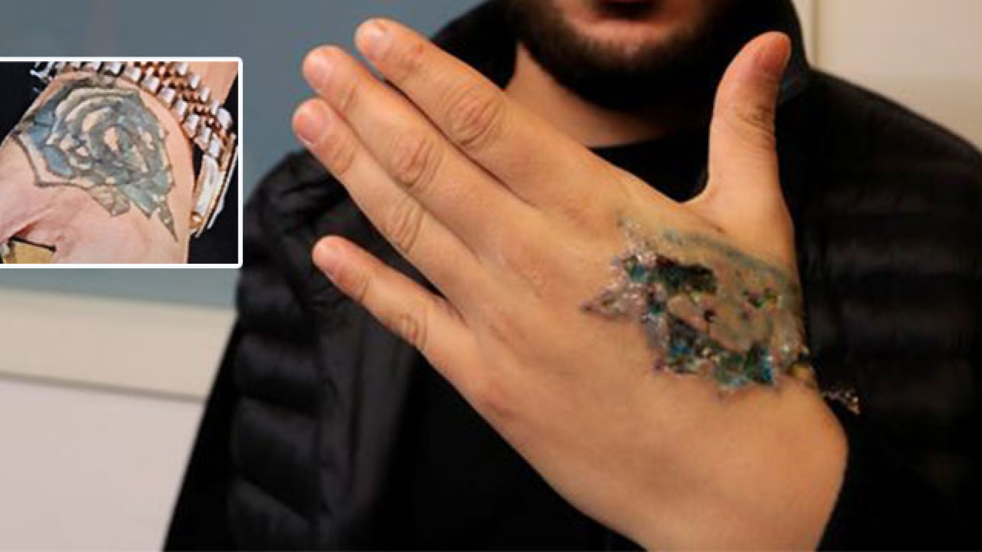 KORKUNÇ OLAY! Dövmesini sildirecekti kâbusu yaşadı | SON DAKİKA HABERİ | Son dakika haberleri