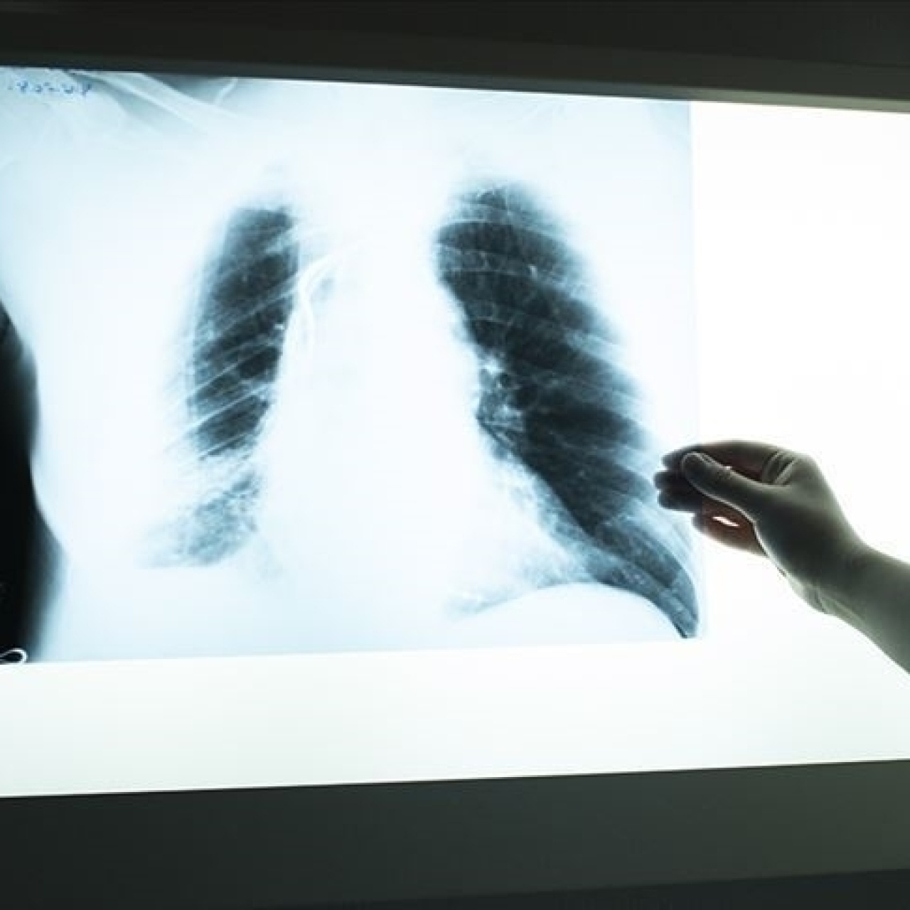 3 haftayı aşan öksürük ve kilo kaybına dikkat!