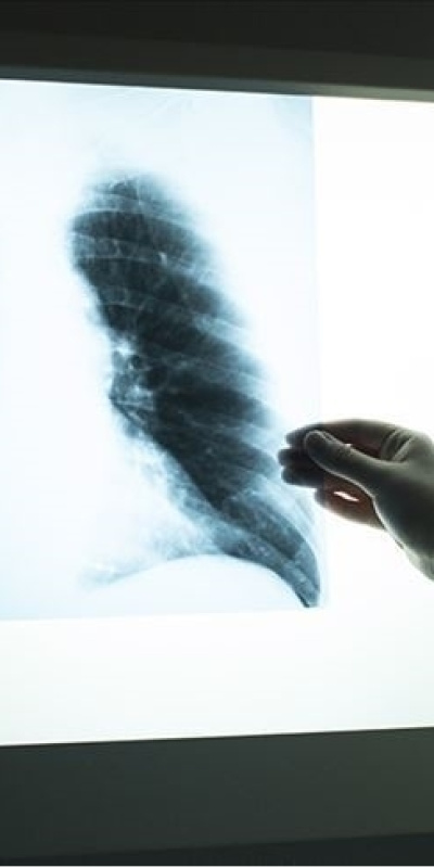 3 haftayı aşan öksürük ve kilo kaybına dikkat!