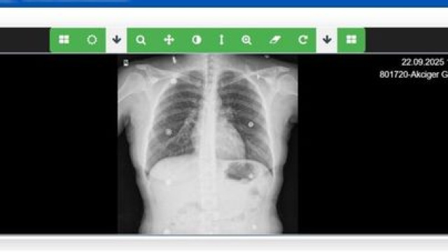 Sağlık Bakanlığı, 'Akciğer Görüntüleme Sistemi'ni hayata geçirdi