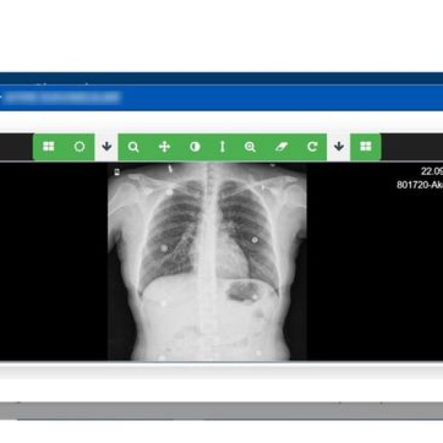 Sağlık Bakanlığı, 'Akciğer Görüntüleme Sistemi'ni hayata geçirdi