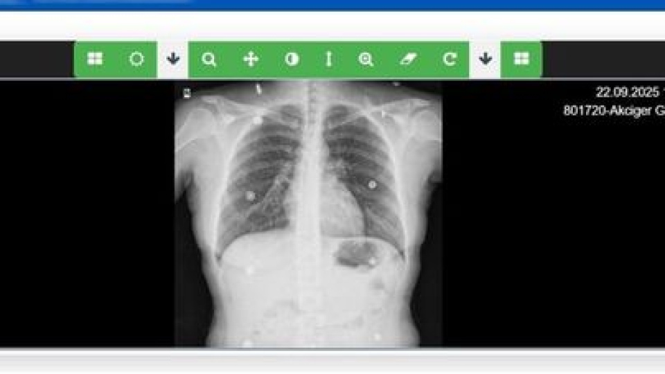 Sağlık Bakanlığı, 'Akciğer Görüntüleme Sistemi'ni hayata geçirdi