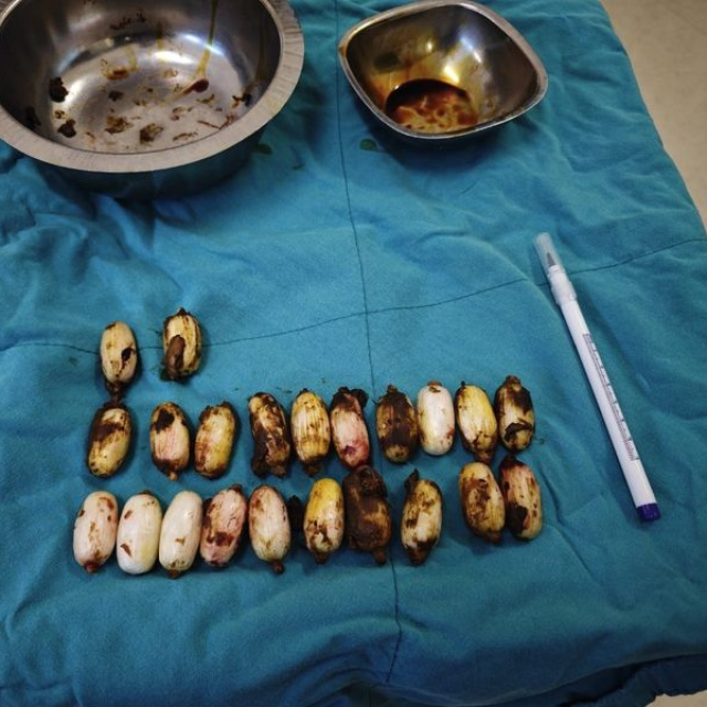 Midesinde 44 kapsül yakalandı