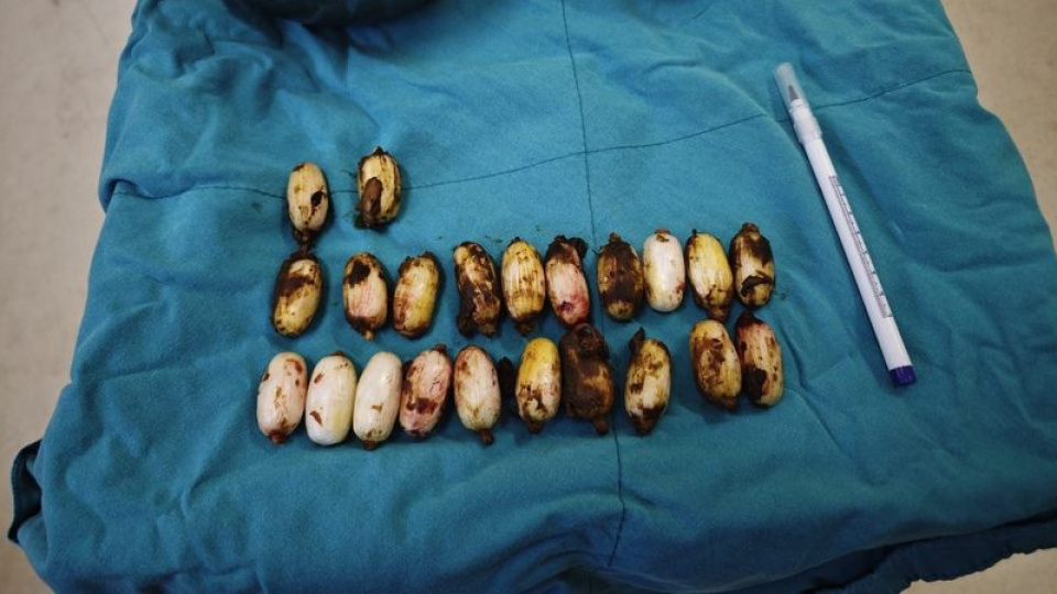 Midesinde 44 kapsül yakalandı