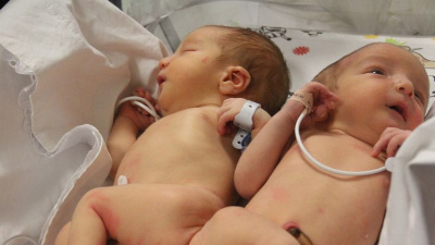 Siyam ikizlerini 9 yaşında ölüm ayırdı