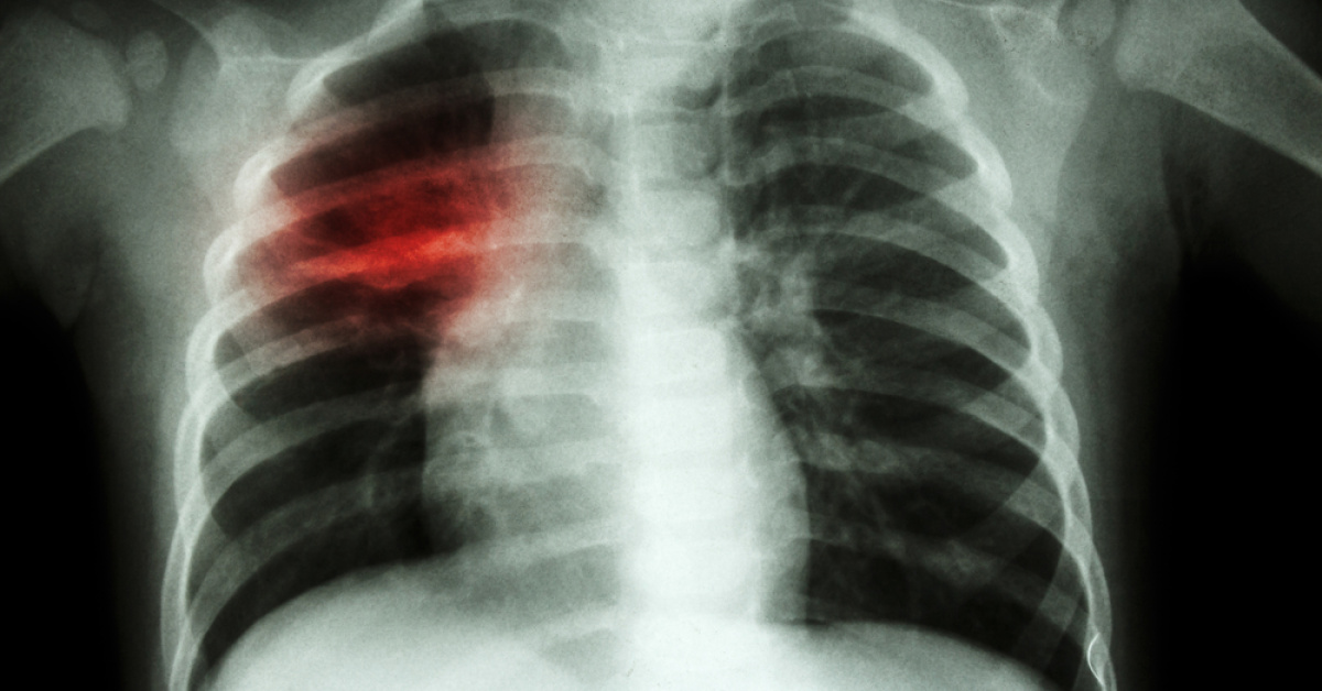 "Grip" deyip geçmeyin! Zatürre tehlikesi...