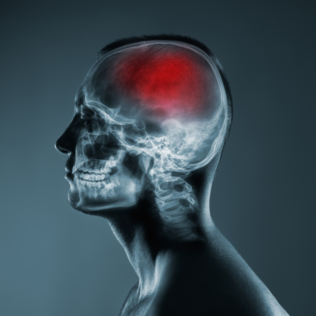 COVID-19 sonrası beyin sisi şikayetleri arttı