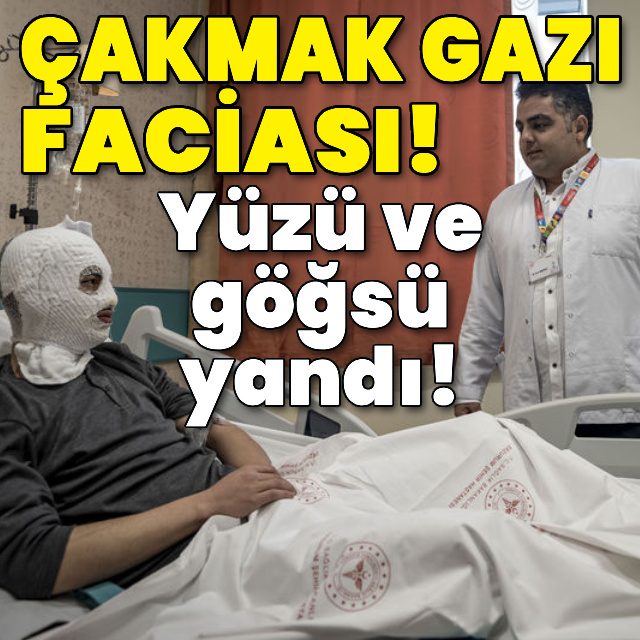 Çakmak gazı faciası! Yüzü ve göğsü yandı!