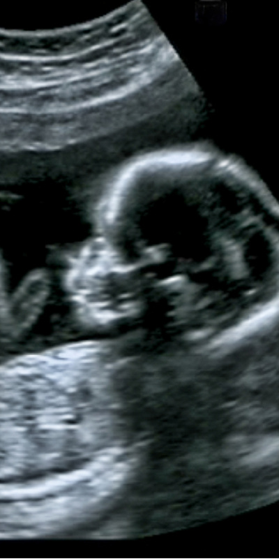 Kalp ve damar sağlığı anne karnında başlıyor