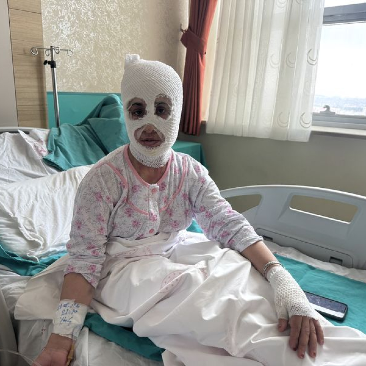 İftar hazırlığında patlayan düdüklü hastanelik etti